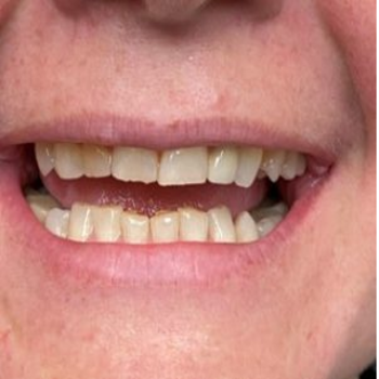 Dental-Cleaning