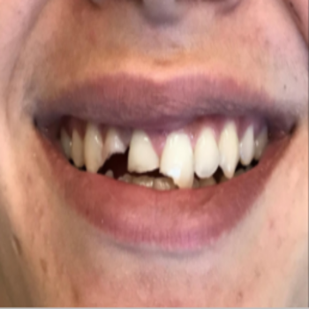 Dental-Cleaning