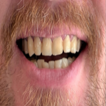 Dental-Cleaning