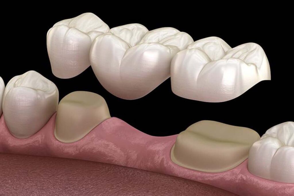 DENTAL BRIDGE SERVICES MIAMI FLORIDA