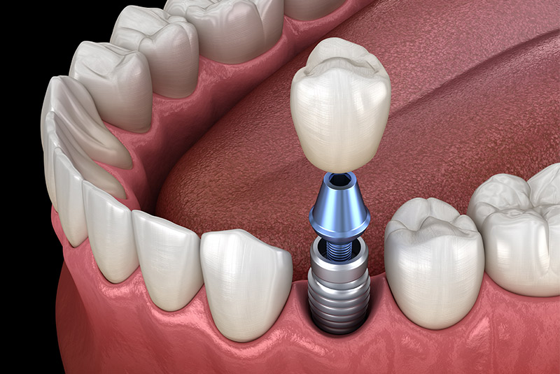 Dental Implant Services Miami Florida