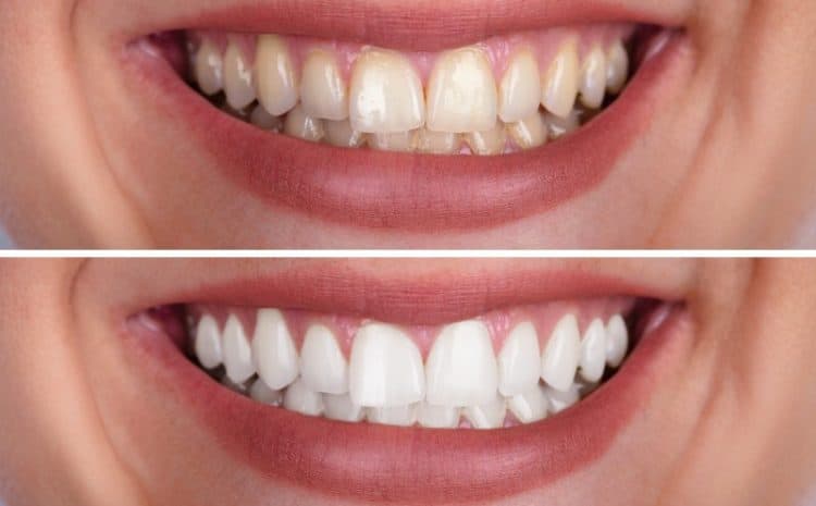 Full Mouth Reconstruction Miami Florida