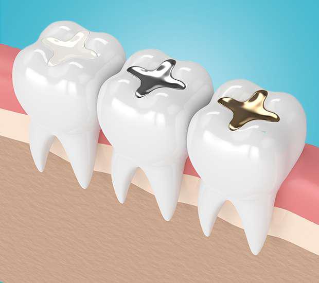 TOOTH COLORED FILLINGS MIAMI FLORIDA