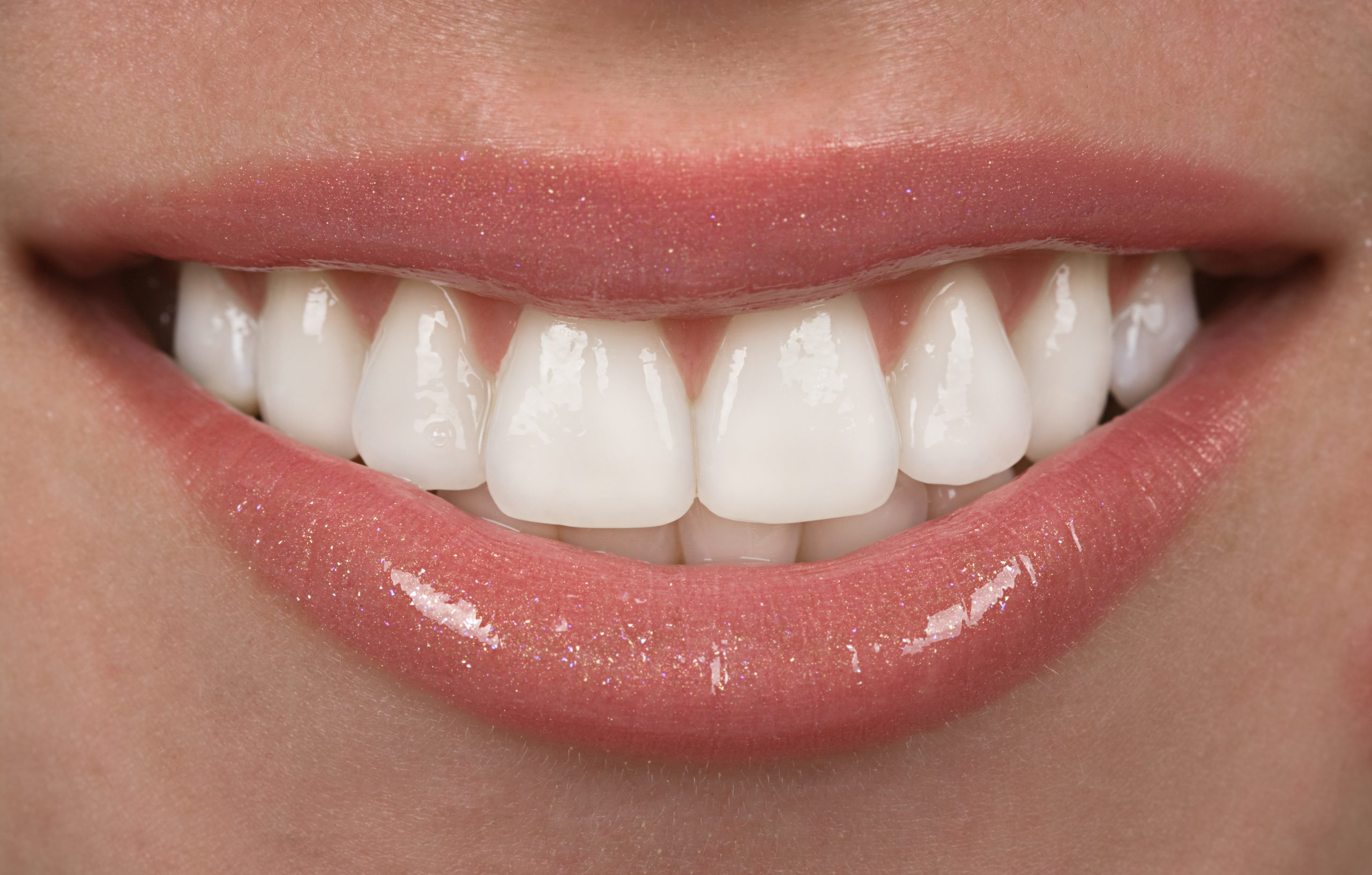 Veneers Miami Florida