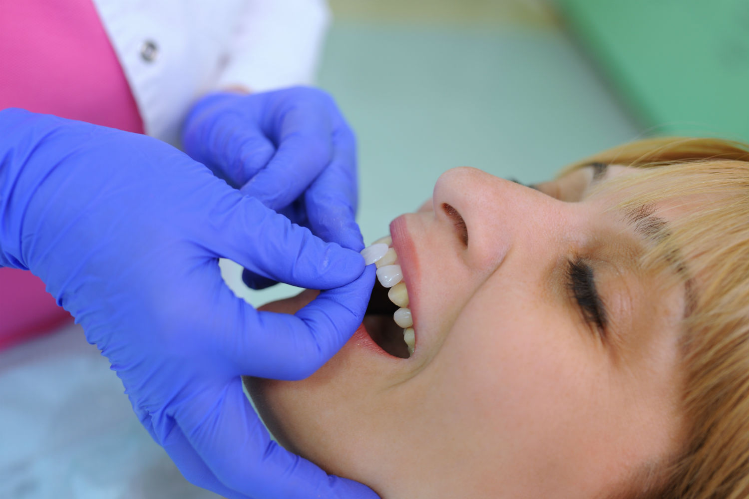 Veneers-being-placed
