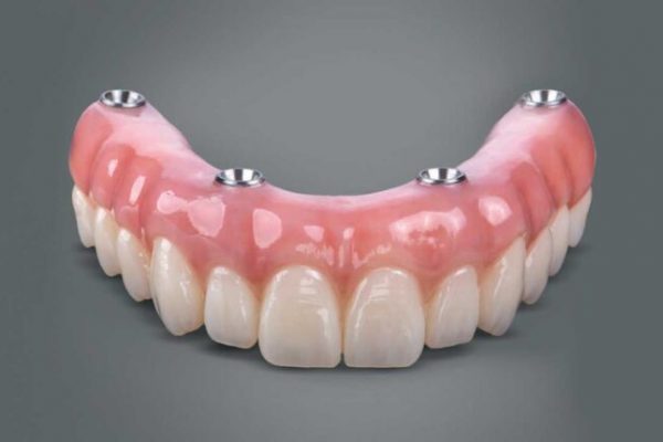 DENTAL BRIDGE