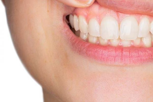 Dental Flap Surgery