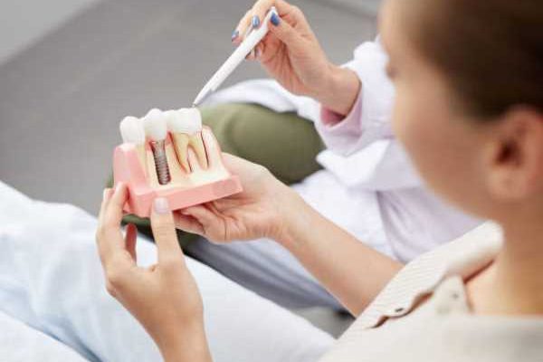 Dental Implant for me Dental Implant for me