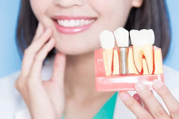 Dental Implant Dental Implant