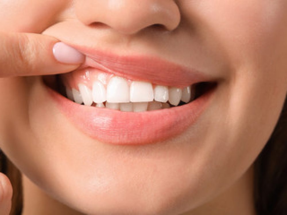 Gum-Flap