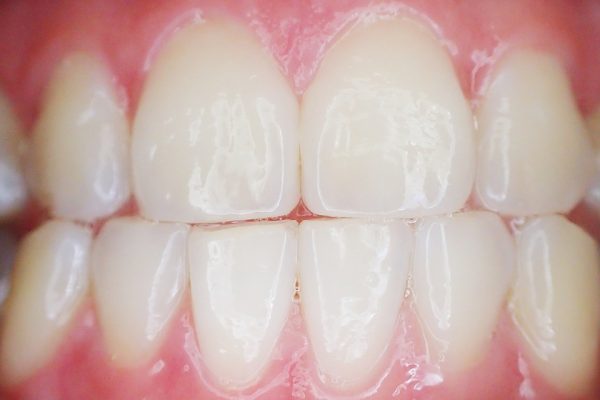 Tooth decay loss